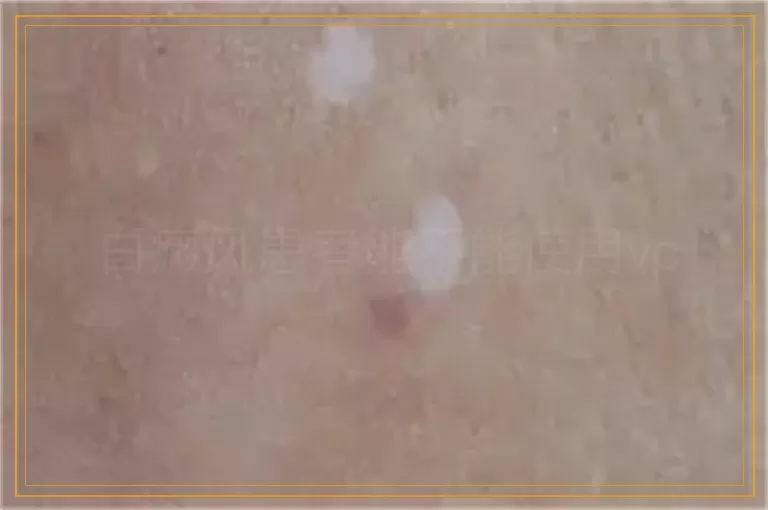 白癜风患者能不能使用vc