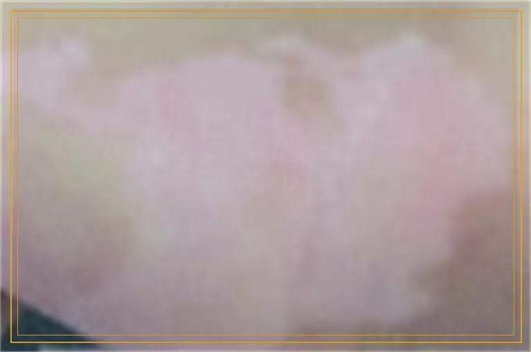 隐私部位白癜风治疗一个月要多少钱