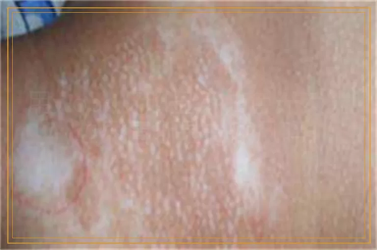 用wood灯照显示白色无荧光边界清晰是白癜风吗