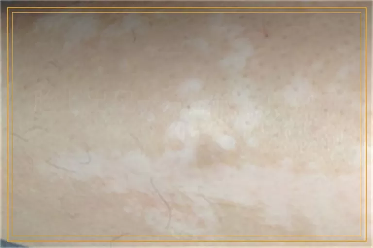 脸上出现一片白块是白癜风吗