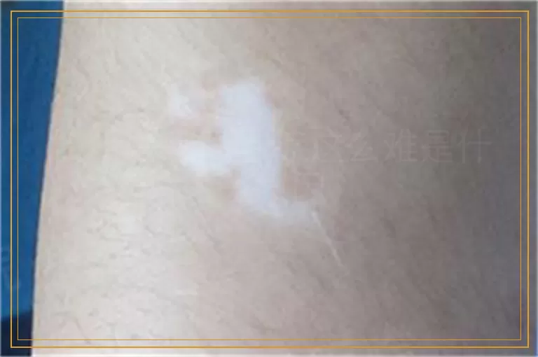 如今白癜风治疗这么难是什么原因