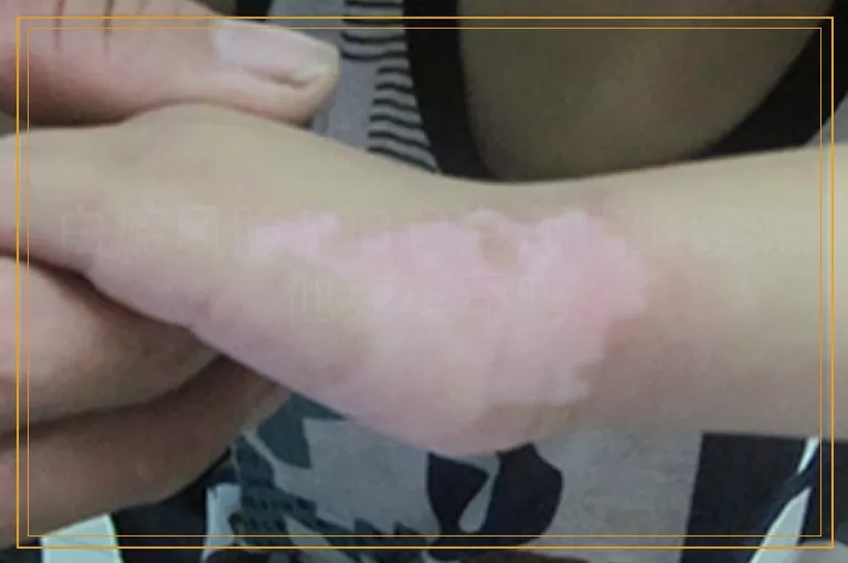 白癜风照308起泡还能继续涂他克莫司吗