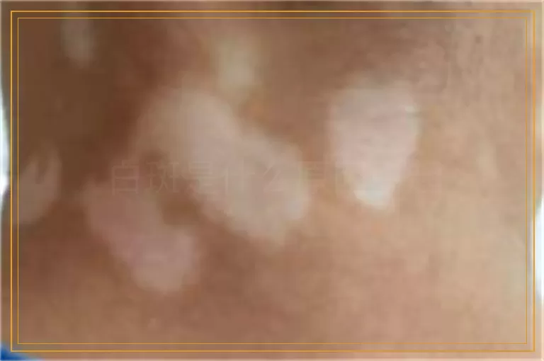 白斑是什么原因引起