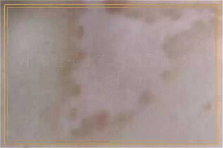 小孩肚子上有白斑是什么原因
