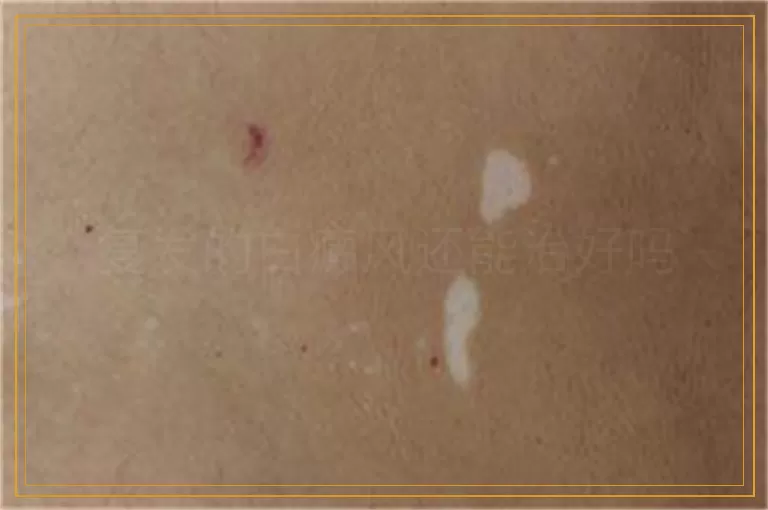 复发的白癜风还能治好吗