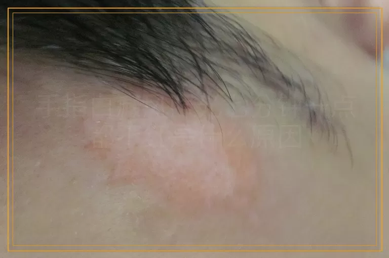 手指白癜风照光七分钟一点都不红是什么原因