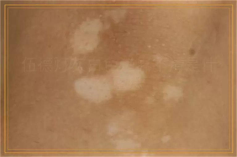 伍德灯灰白色边界不清是什么意思