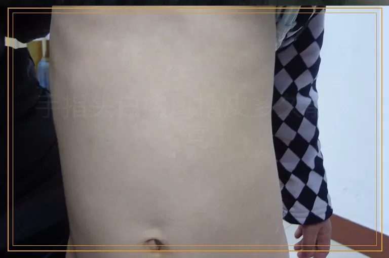 手指头白癜风植皮多久能恢复