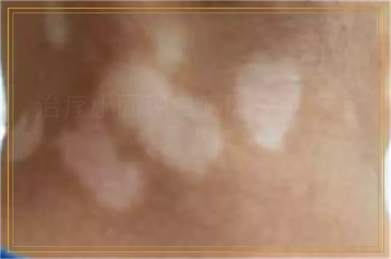 治疗小面积白癜风一个疗程多少钱