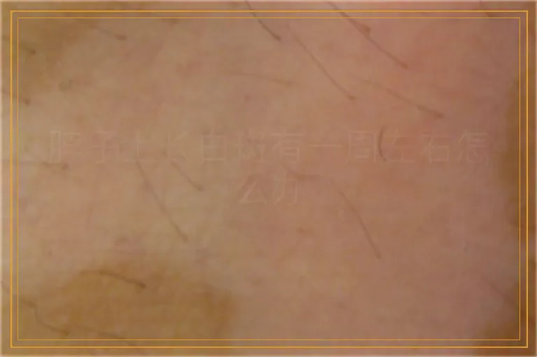 脖子上长白斑有一周左右怎么办