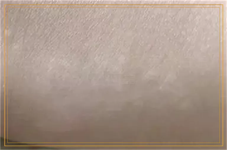 白癜风激光后脱皮有点白怎么回事