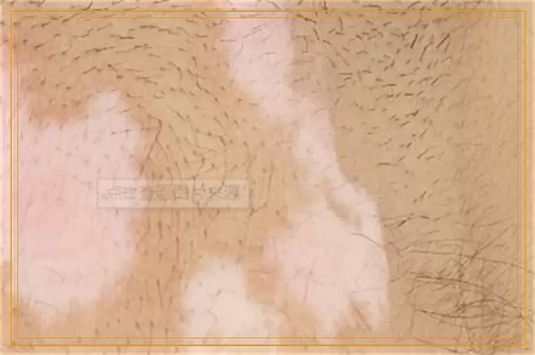 哪些药物能够促进白癜风黑色素细胞增长