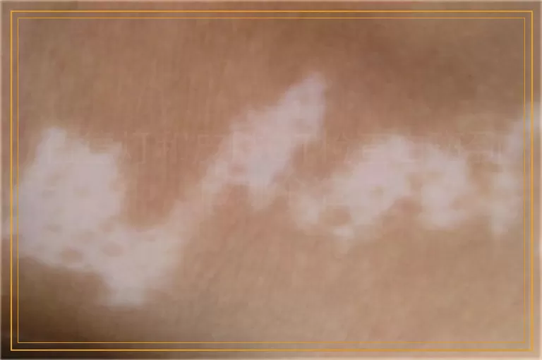 伍德灯和皮肤CT检查白斑到底哪个准