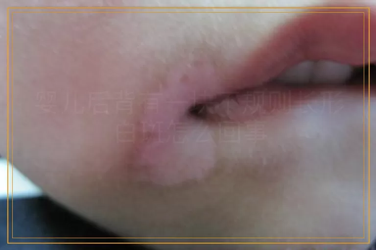 婴儿后背有一块不规则长形白斑怎么回事