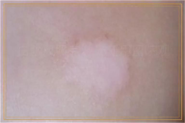 白癜风照完激光还用留院观察吗