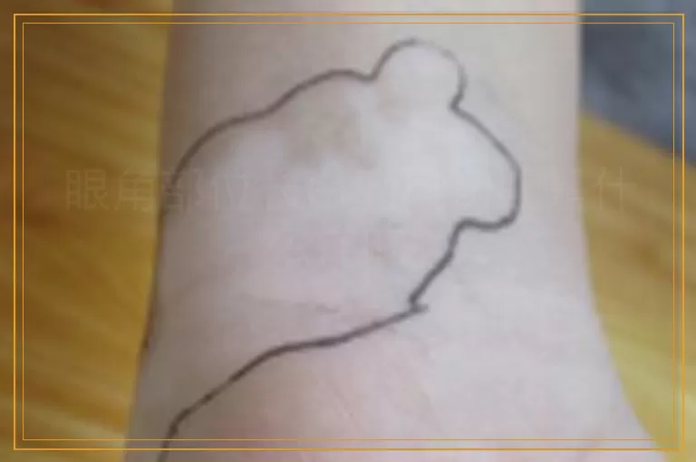 眼角部位长白癜风初期是什么样的? 眼角部位长白癜风初期是什么样的?