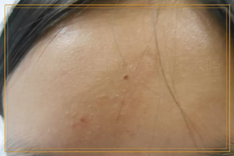 308激光治白斑恢复几率大吗