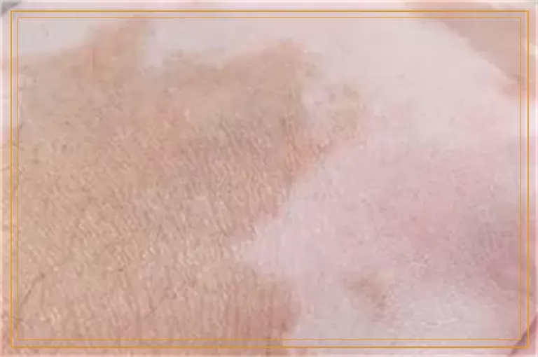 308准分子激光治疗白癜风的优势是什么