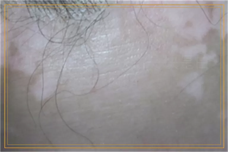 儿童脸上黑一块白一块是白癜风吗