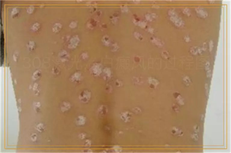 308激光治白癜风的过程图