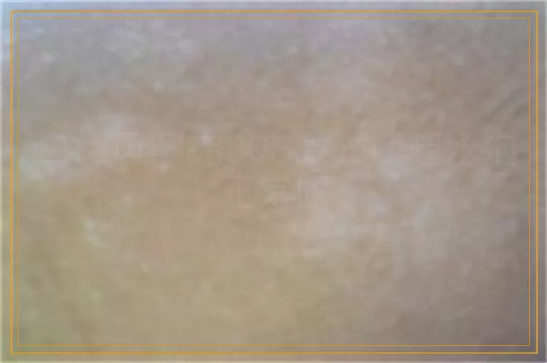 白癜风照完308激光后起水泡正常吗