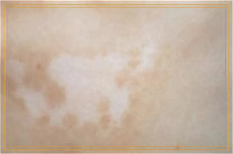 极速308激光治疗脸上的白癜风效果好吗