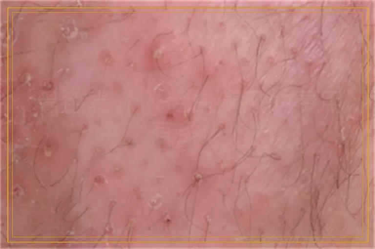 黑色素介入治白癜风的费用有多少