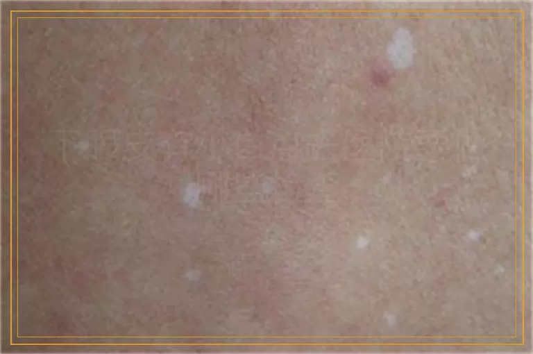 下眼皮有小白点去医院要做哪些检查