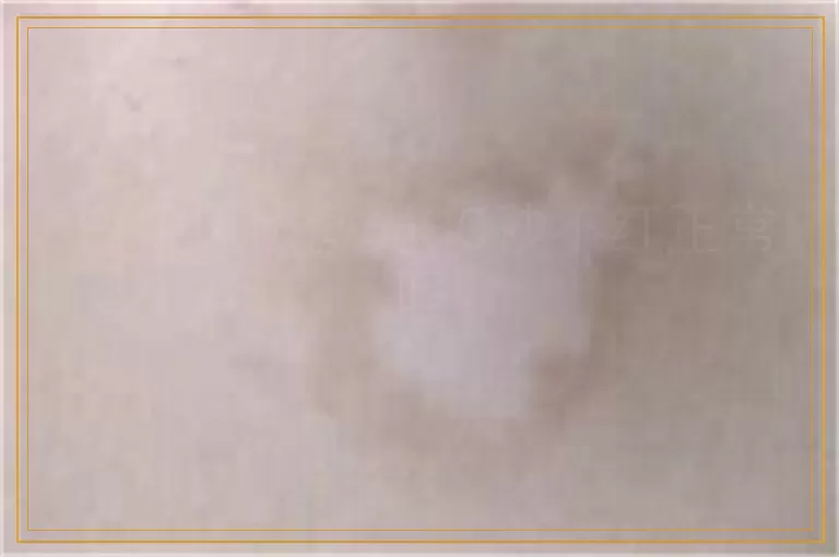 白癜风照激光30秒不红正常吗