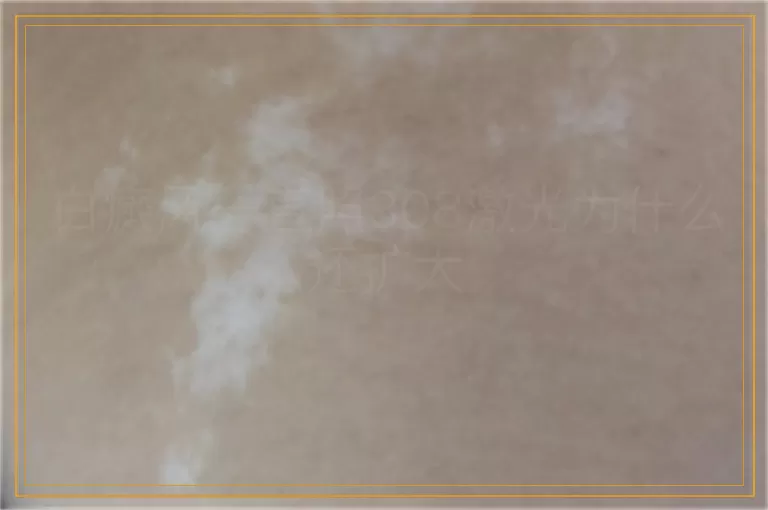 白癜风一直照308激光为什么还扩大