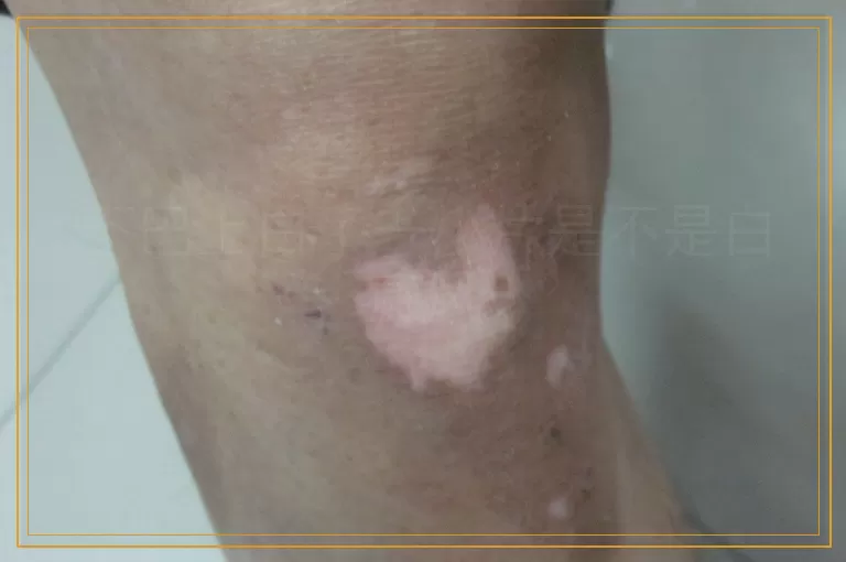下巴上白了一小片是不是白癜风