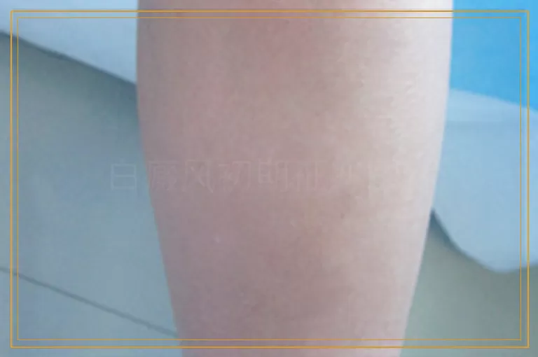 白癜风初期征兆图片