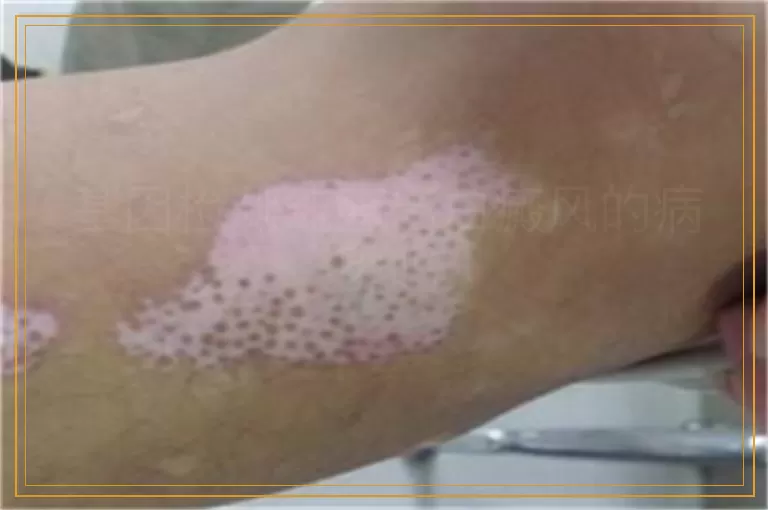 基因检测能查出白癜风的病因吗