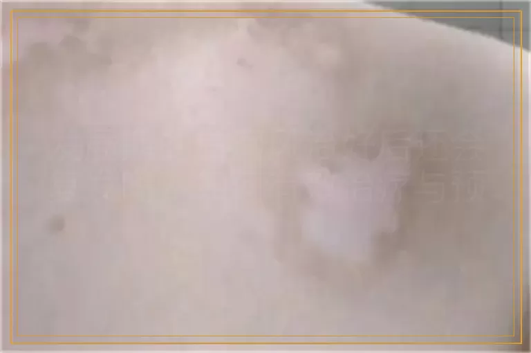 发展期的白癜风治好后还会复发吗?如何有效治疗与预防复发 发展期的白癜风治好后还会复发吗?如何有效治疗与预防复发