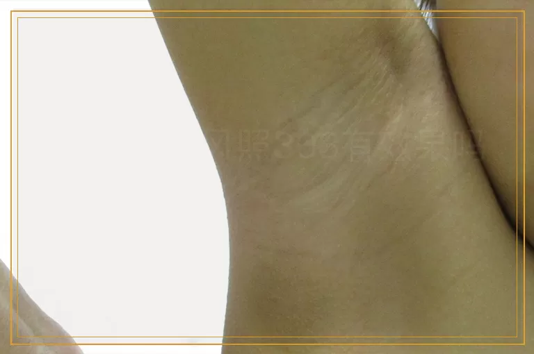 嘴部白癜风照308有效果吗