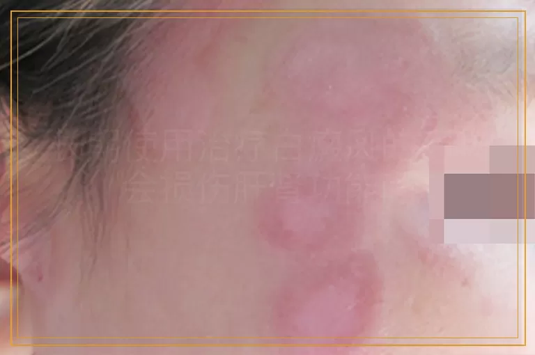 长期使用治疗白癜风的药物会损伤肝肾功能吗