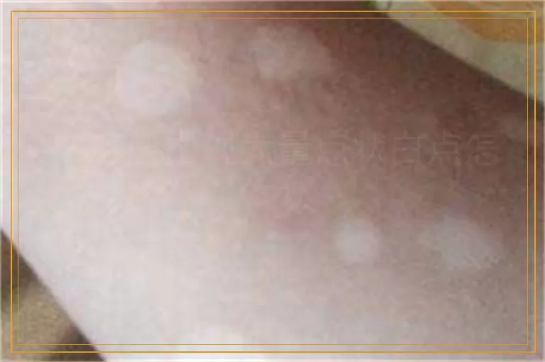 白癜风出现大量点状白点怎么办