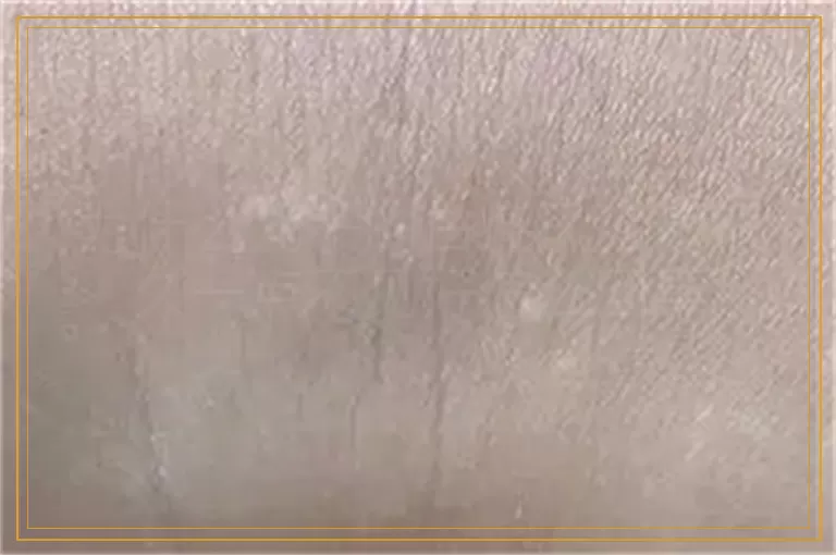 为什么儿子的白癜风治疗很久一点不见好怎么回事