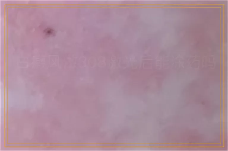 白癜风做308激光后能涂药吗