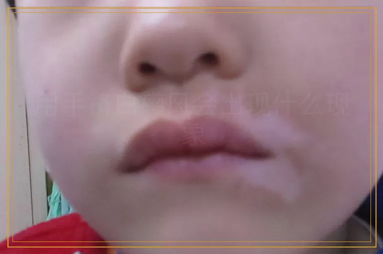 用手挤白癜风会出现什么现象