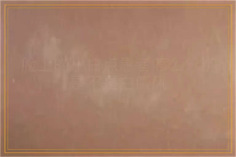 脸上的小白点患者怎么分辨是不是白癜风