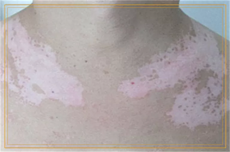 白癜风照308激光几个疗程出黑点