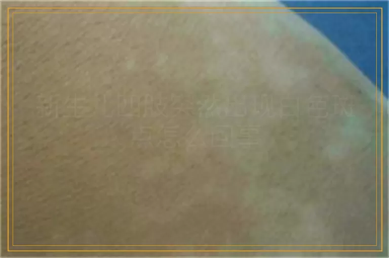 新生儿四肢突然出现白色斑点怎么回事