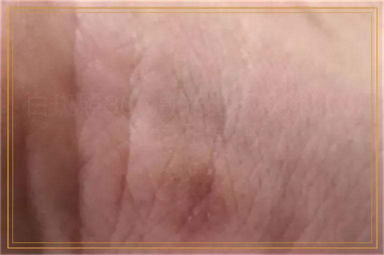 白斑照308激光出现淡淡的粉红色正常吗