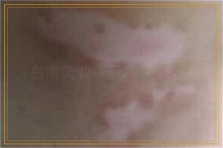 白癜风做一回308多少钱