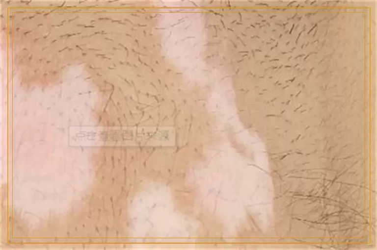 宝宝嘴巴下面皮肤白一块怎么回事