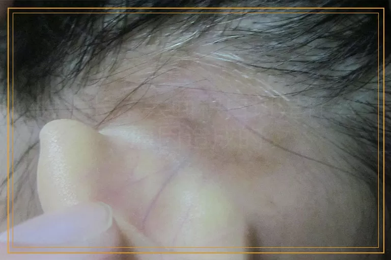 脸上长了大面积白斑是什么原因造成的