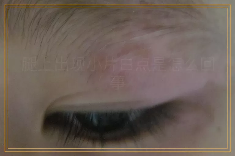 腿上出现小片白点是怎么回事