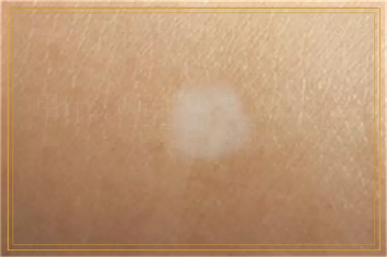 用什么仪器可以看出白斑是不是白癜风