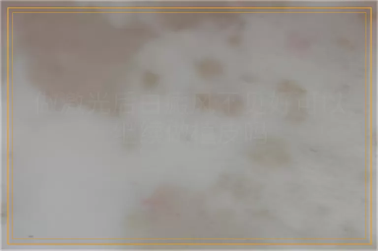 做激光后白癜风不见好可以继续做植皮吗